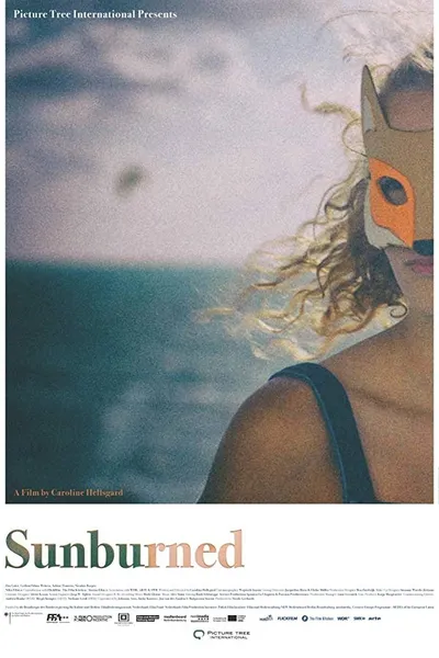 Sunburned